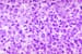 B-Cell Lymphoma