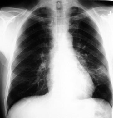 Coccidioidomycosis Imaging: Overview, Radiography, CT Scan