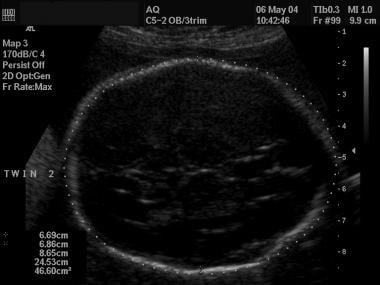 Ultrasonographic image of a fetal head, with measu