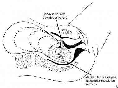 Sac ultrasound tilted uterus empty 6 weeks
