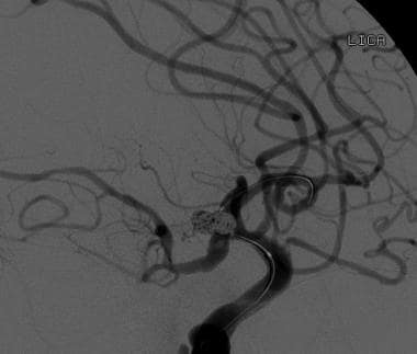 Lateral view of a selective injection of the left 