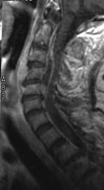 The epidural abscess on this contrast-enhanced T1-