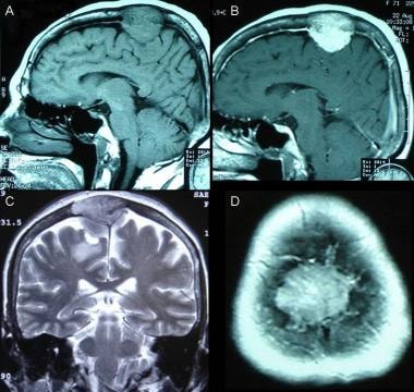 Parasagittal meningioma. A: Nonenhanced sagittal T