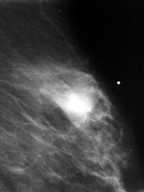 Breast cancer, ultrasonography. Digital spot compr