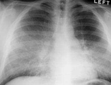 Frontal chest radiograph in a patient with pulmona