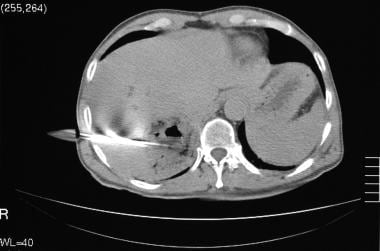 CT scan in the same patient as in the previous ima