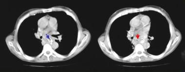 Nonenhanced CT scan through the mid esophagus in a