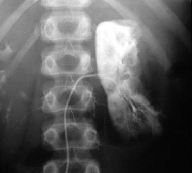 Selective left renal angiogram showing 2 tumors, w