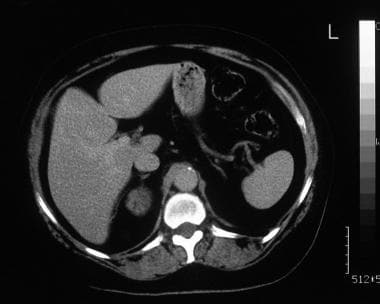 A 59-year-old man was referred for renal ultrasono