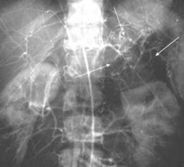 Abdominal aortogram in a patient with pheochromocy