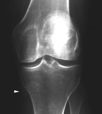 Anteroposterior radiograph of the knee shows calci