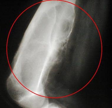Lateral radiograph of the distal femur of a 14-yea