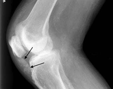 Lateral radiograph of the knee in a patient with c