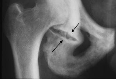 Anteroposterior radiograph of the right hip, coned