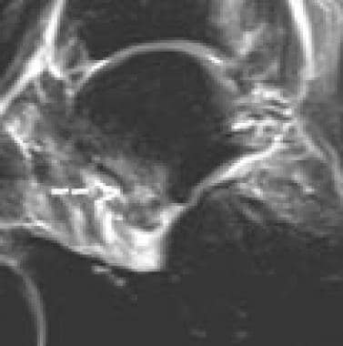 Patient OA. Lateral process fracture; sagittal, fa