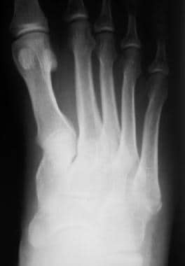 Fractured metatarsals. Fracture of the fifth metat