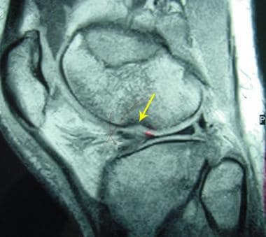 Pivot-shift osteochondral fracture of the lateral 