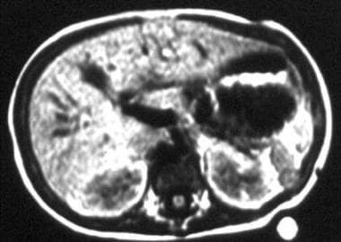 T1-weighted magnetic resonance image obtained in a