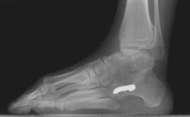 Lateral radiographs obtained in a 12-year-old girl