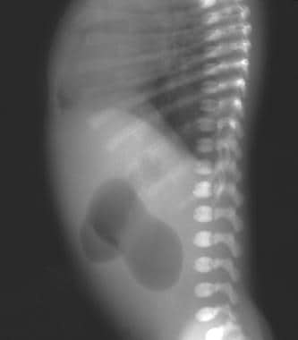Lateral radiograph demonstrates the double-bubble 