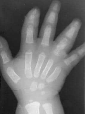 Skeletal sickle cell anemia. Hand-foot syndrome. S