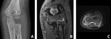 A 4-year-old child with medial epicondyle fracture
