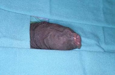 Phimotic foreskin. The distal foreskin is edematou