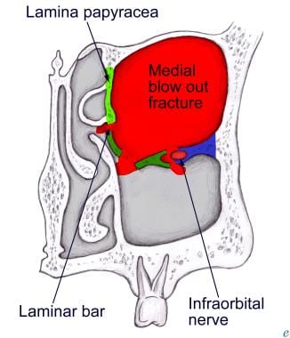 Illustration of a medial blow-out fracture. Note t