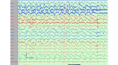 Electroencephalogram demonstrating a left temporal