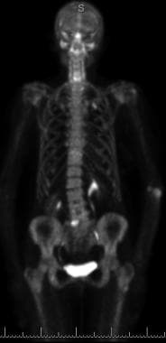 18F-NaF PET/CT bone scan. This is the PET-only MIP