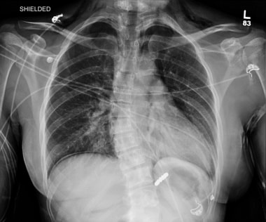 Hiatal Hernia. This image demonstrates a Linx devi