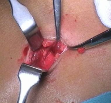 Penetrating lateral wound. (The exploration of thi