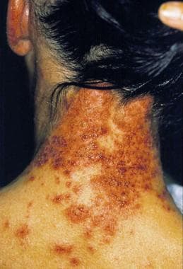 Erythema multiformelike reaction that developed ac