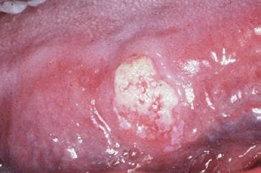 Carcinoma referred to as a leukoplakia. 