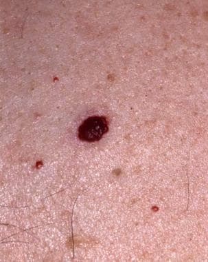 Cherry Hemangioma: Practice Essentials, Pathophysiology, Etiology