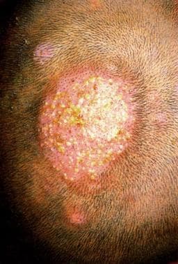 ringworm in humans on head