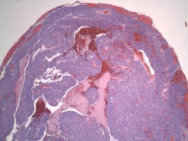 Irregular lobules and sheets of atypical sebaceous