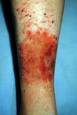 Asteatotic dermatitis on the lower extremity. 