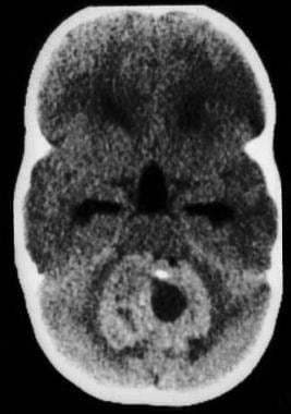 CT scan without contrast, axial view, demonstrates