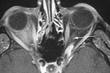 MRI demonstrates enhancing mass in apex of left or