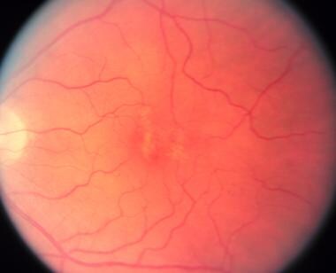 Adult vitelliform macular dystrophy resembles Best