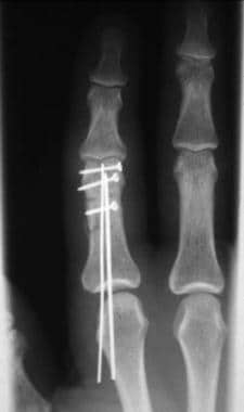 distal phalanx fracture