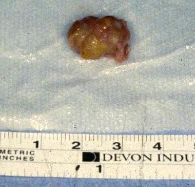 Giant cell tumor of the tendon sheath after margin