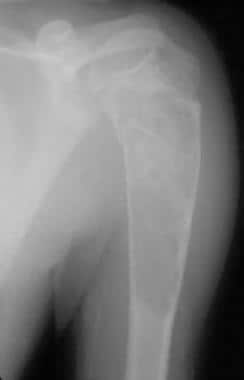 Large proximal humeral unicameral bone cyst demons