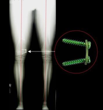 One year following guided growth of the femur with