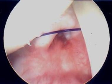 View from posterior portal of "interval closure"; 