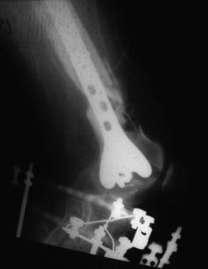 Supracondylar femur fracture treated with a suprac