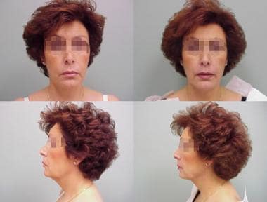Woman aged 58 years. Left – Preoperative. Right - 