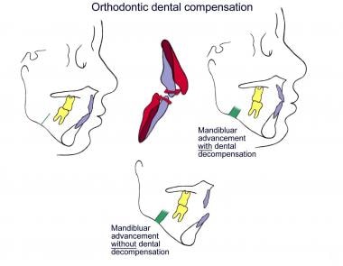 Illustration of the role of presurgical dental dec