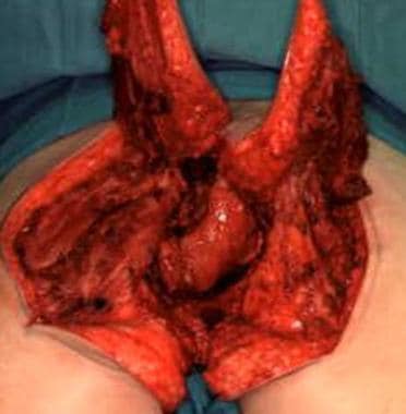 Perineal reconstruction. Bilateral split gluteal f